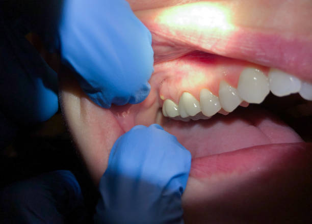 Best Emergency Dentist for Knocked-Out Tooth in Gillette, WY